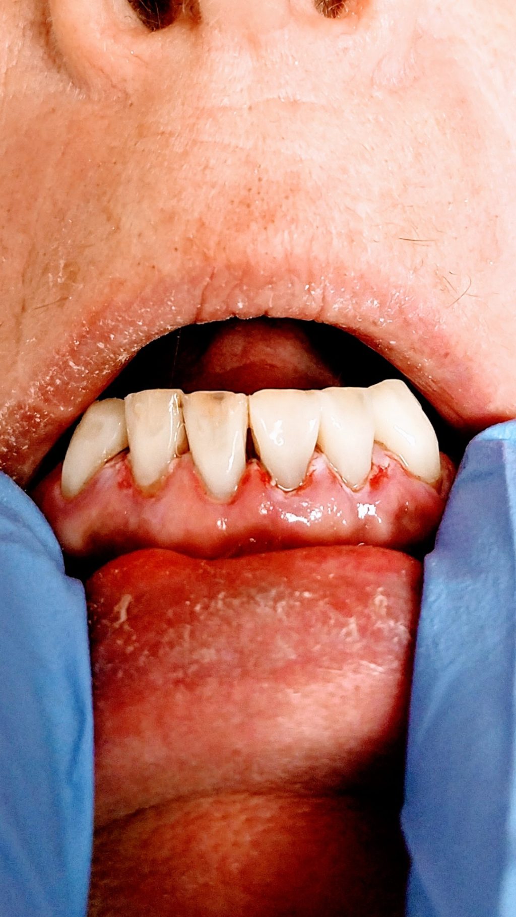 Before & After Edgewood Dental